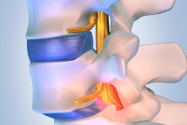 Vertebral sliding - APEX Spine 2023